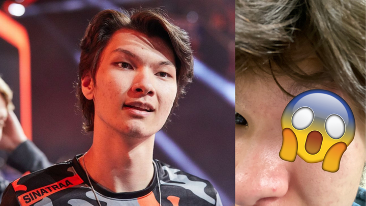 Sinatraa reveals nasty eye injury that will keep him off Valorant for weeks